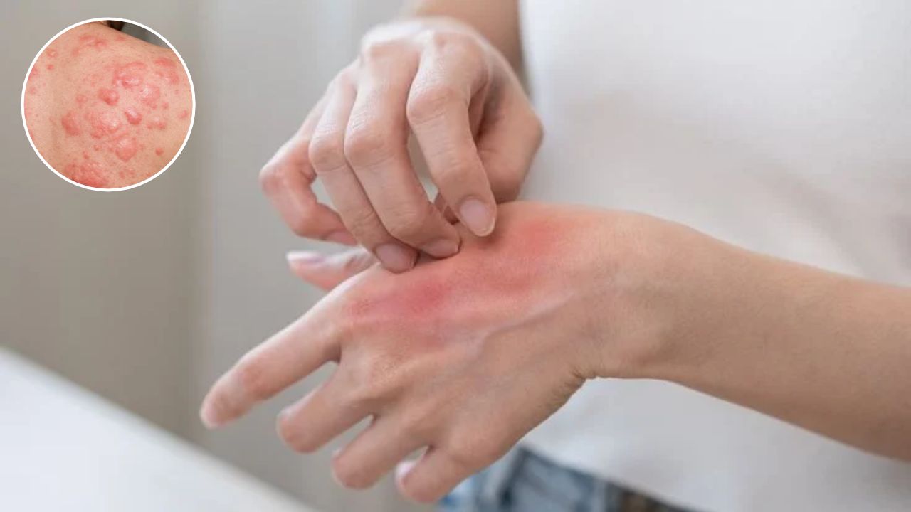 Skin Allergy: बार-बार उभर रहे हैं लाल चकत्ते, कहीं क्रॉनिक यूर्टिकेरिया तो नहीं? जानिए कब डॉक्टर को दिखाना जरूरी