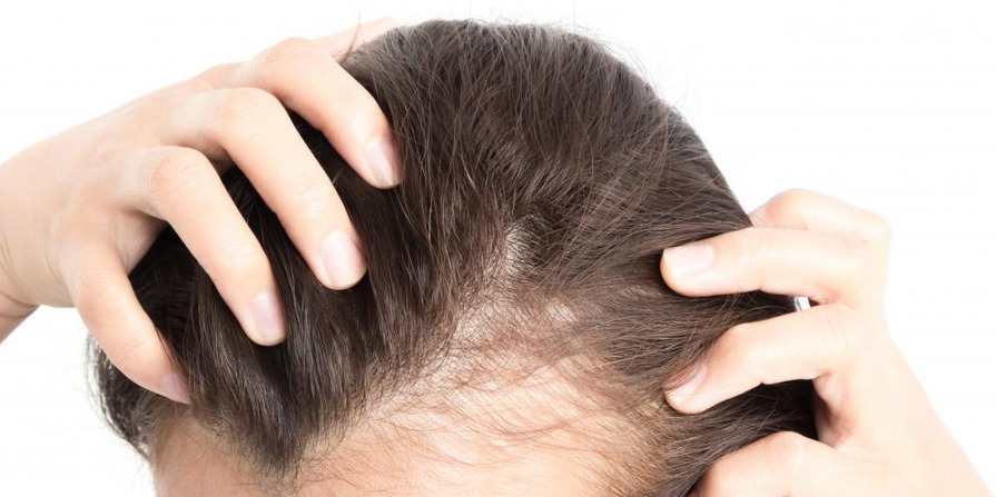 Female Pattern Baldness In Woman S Scalp Imresizer