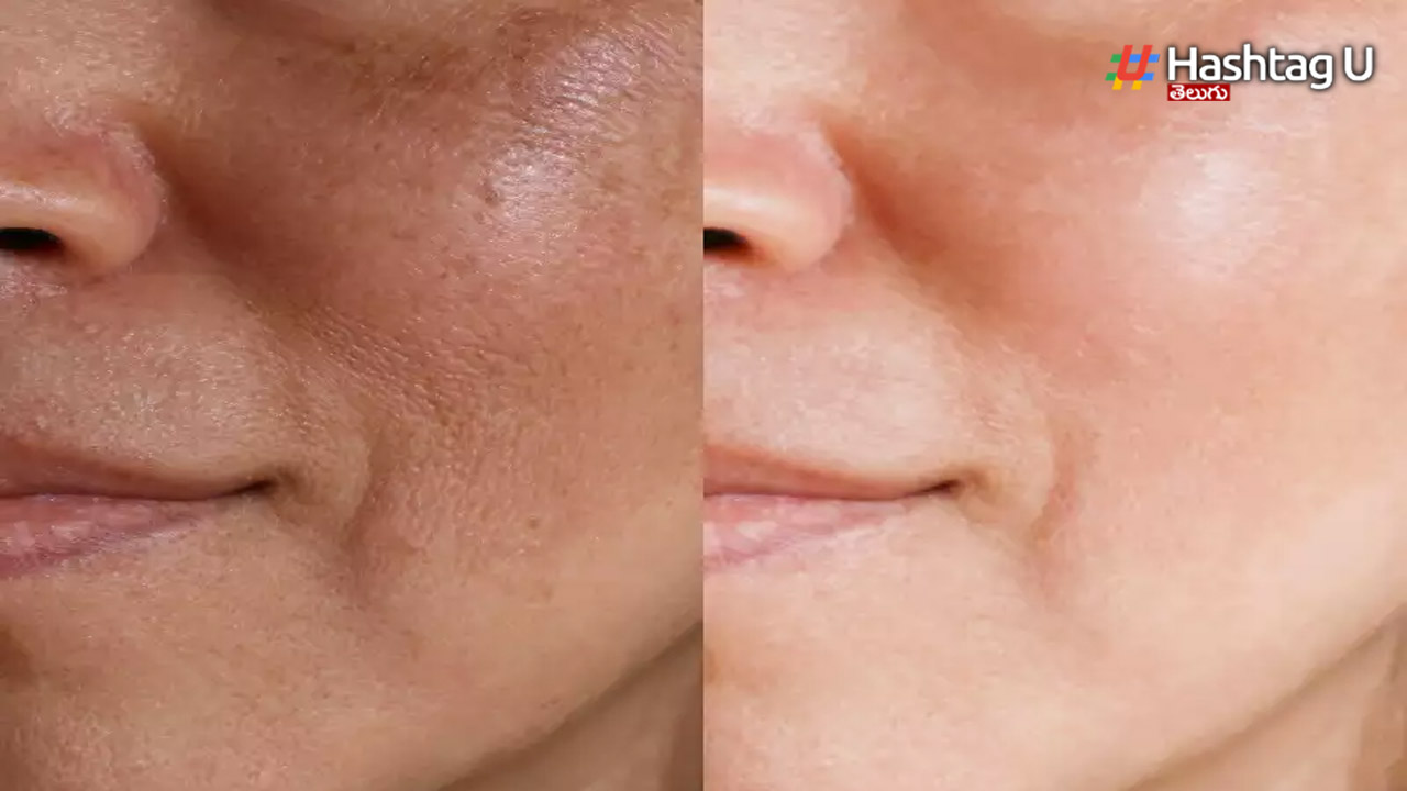 Pores On Face