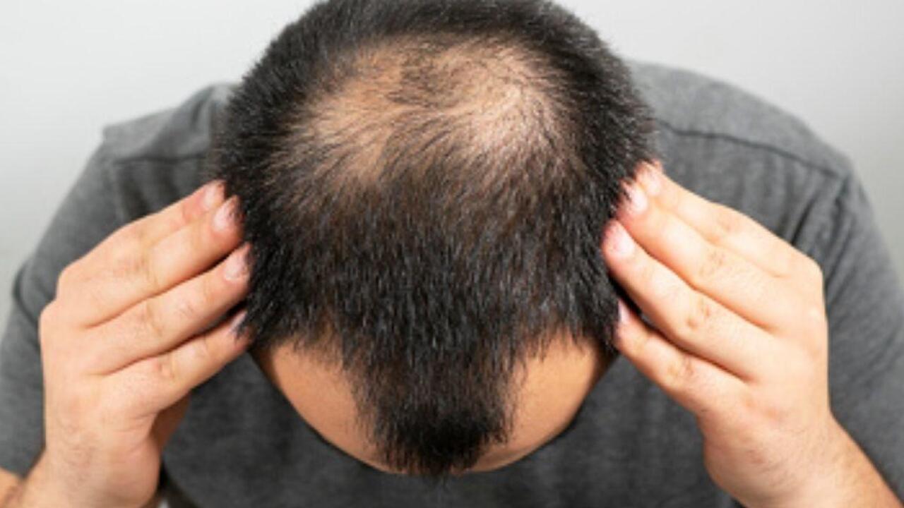 Baldness