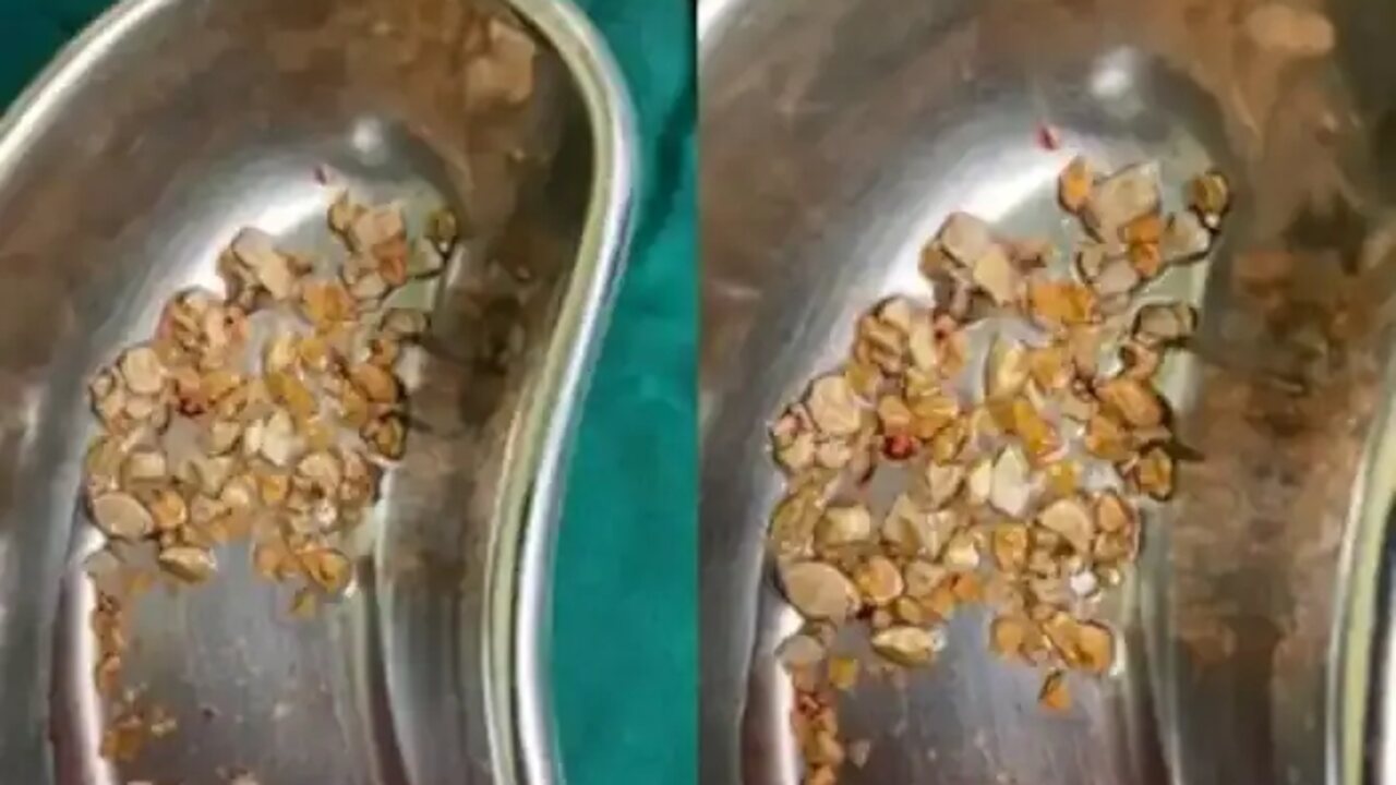 kidney stones