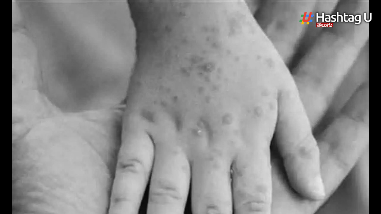 Monkey Pox