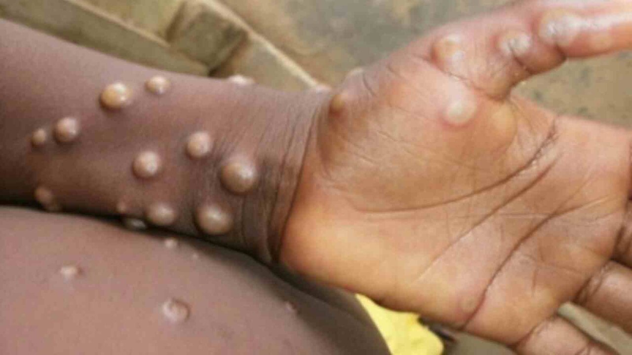 monkeypox