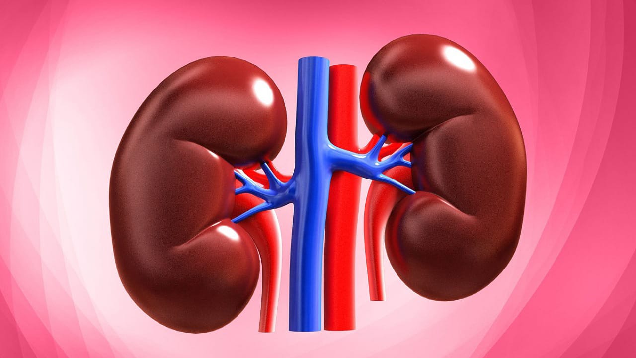 Kidney Stones