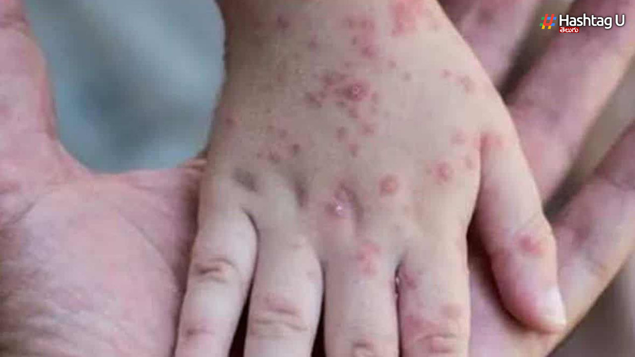 Monkeypox