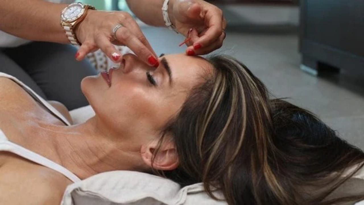 Acupunture