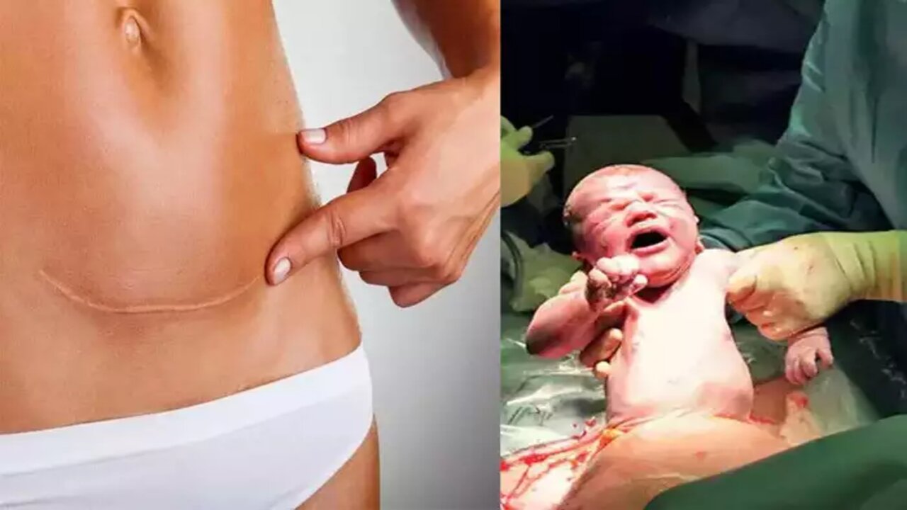 C Section