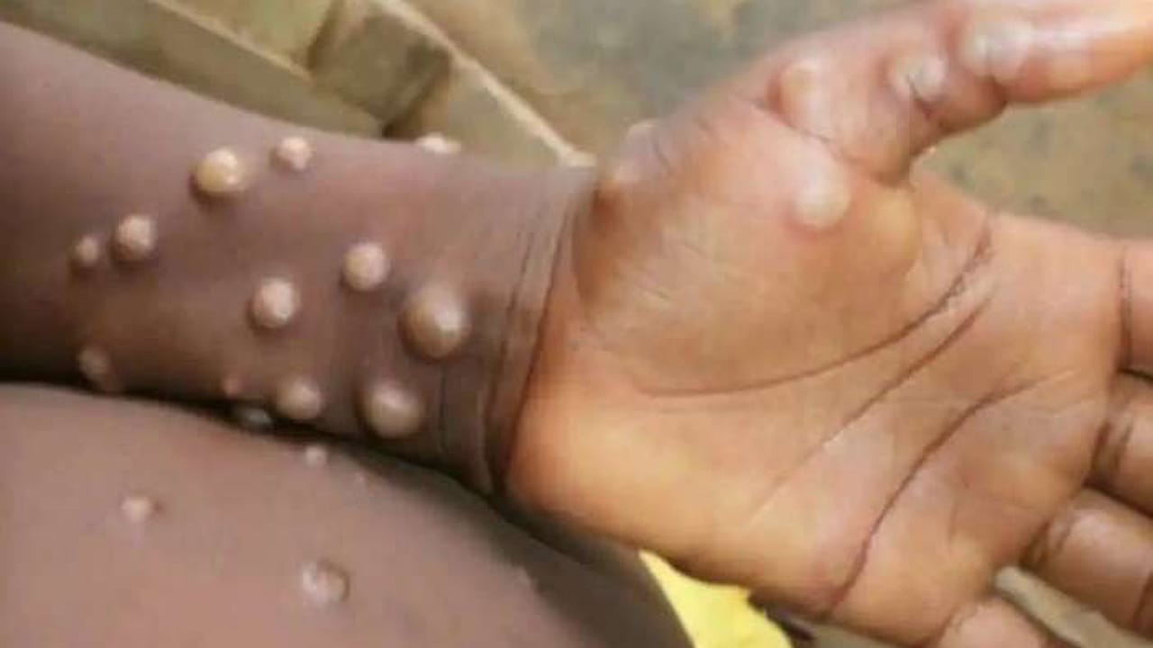 Mpox