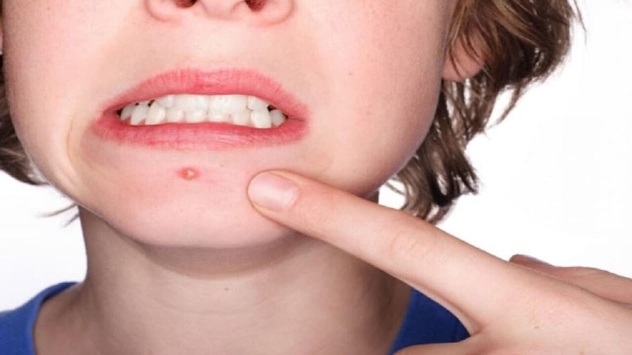 Pimple