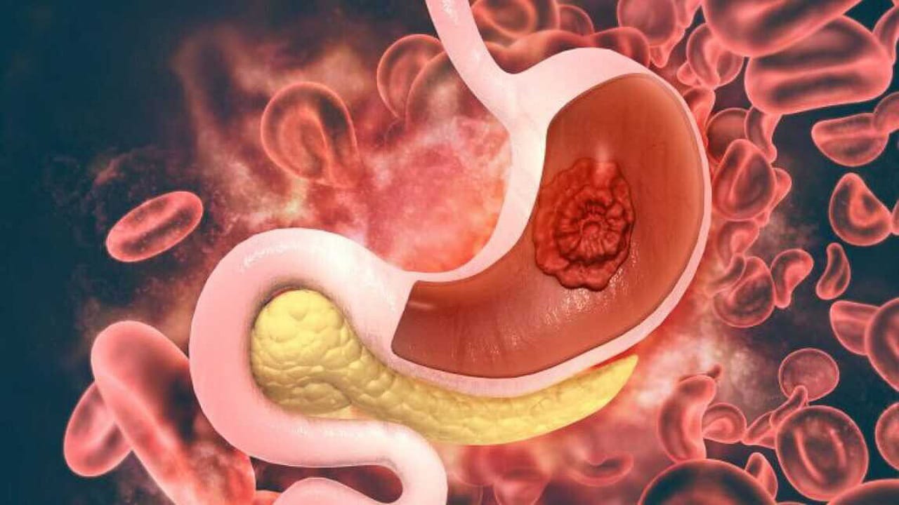 Stomach Cancer