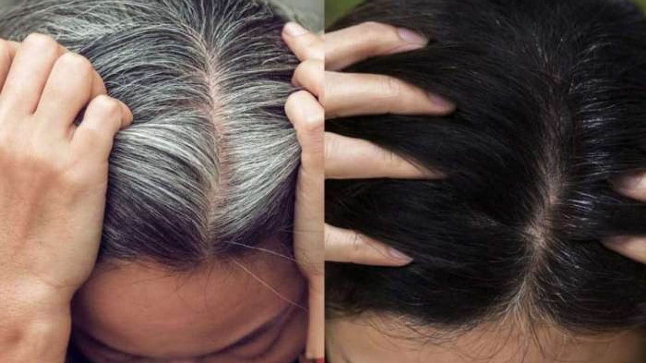 Premature Hair Greying
