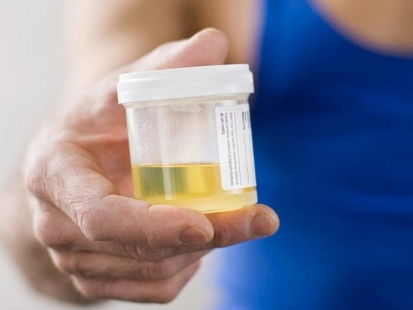 Urine Yellow