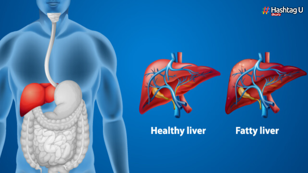 Fatty Liver Symptoms