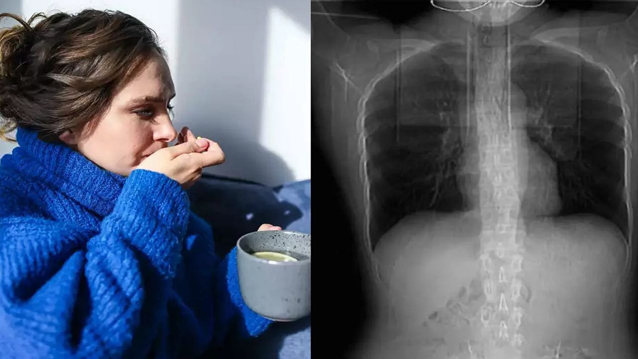 Fractured Ribs