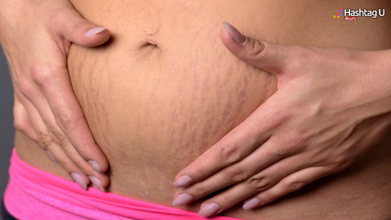 Stretch Marks