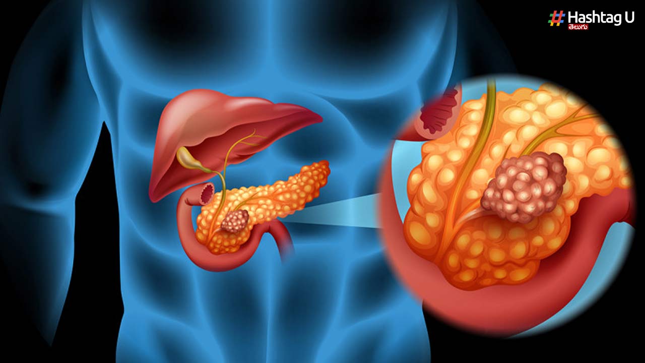 Pancreatic Cancer Pancreas