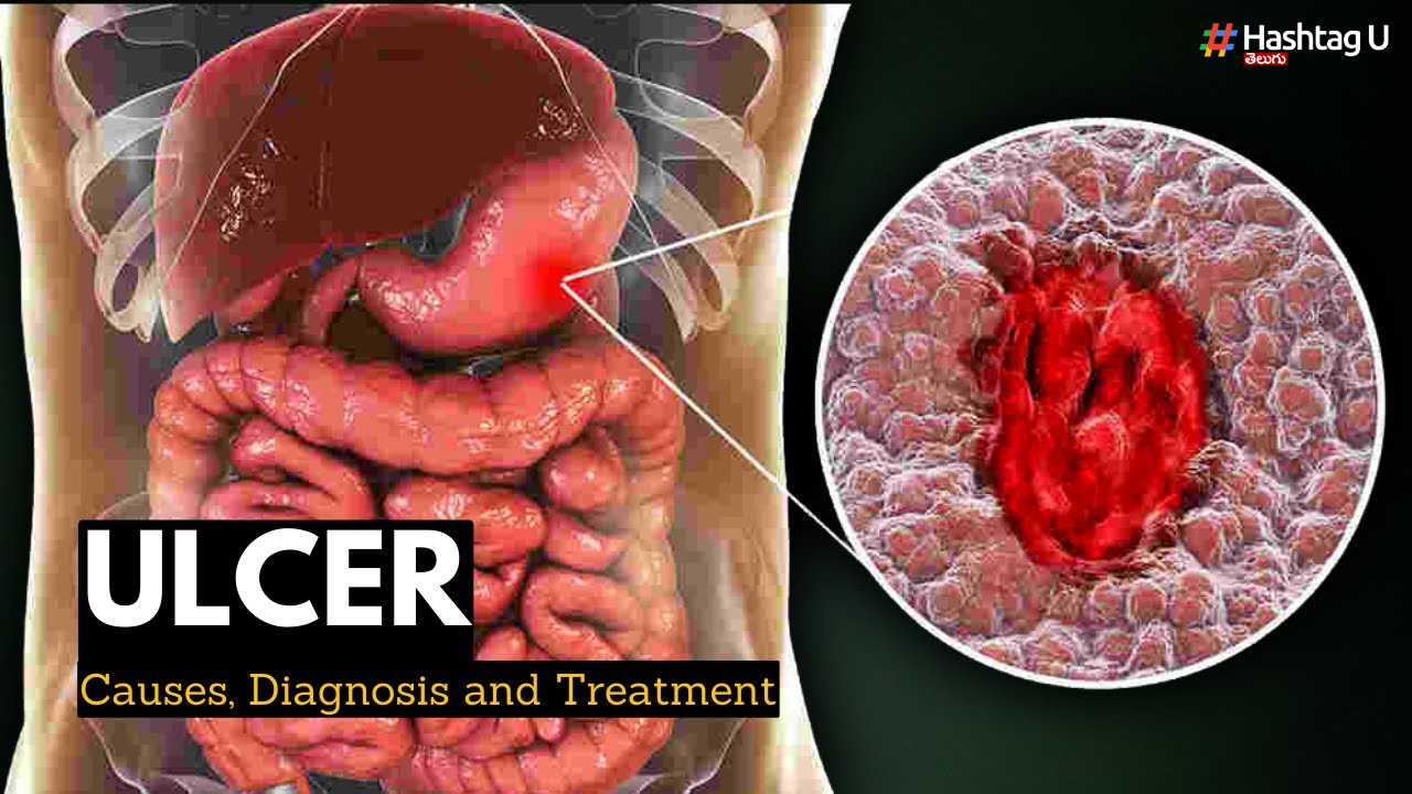 Flaky Ulcers.. Causes, Solutions