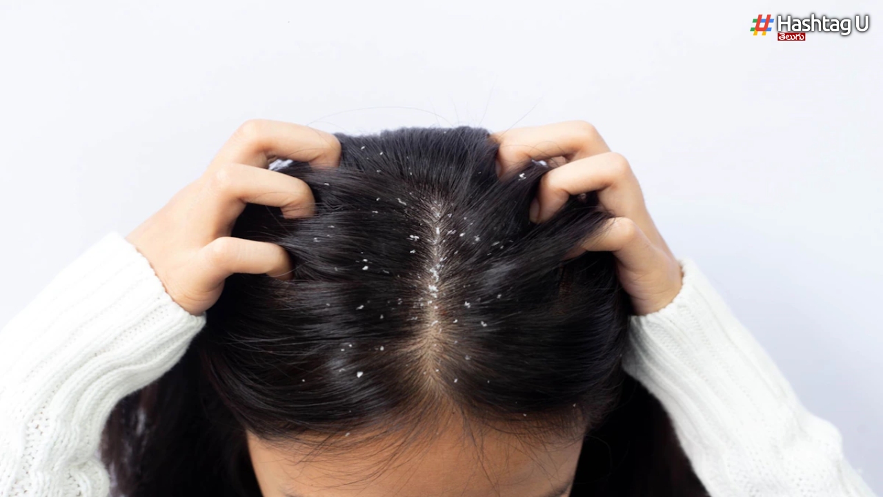 Dandruff