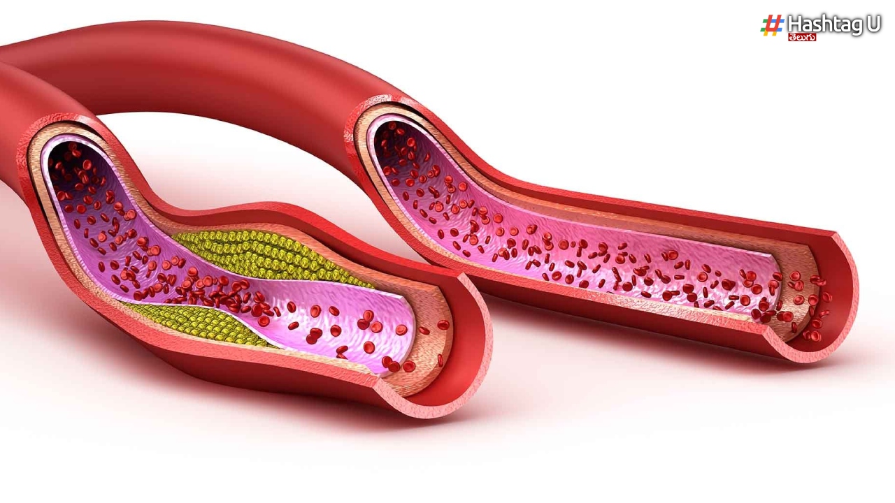 If You Follow These Tips, High Cholesterol Will Melt Away Quickly.
