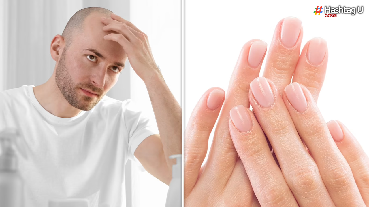 Are Your Fingers Like That.. But Baldness Comes