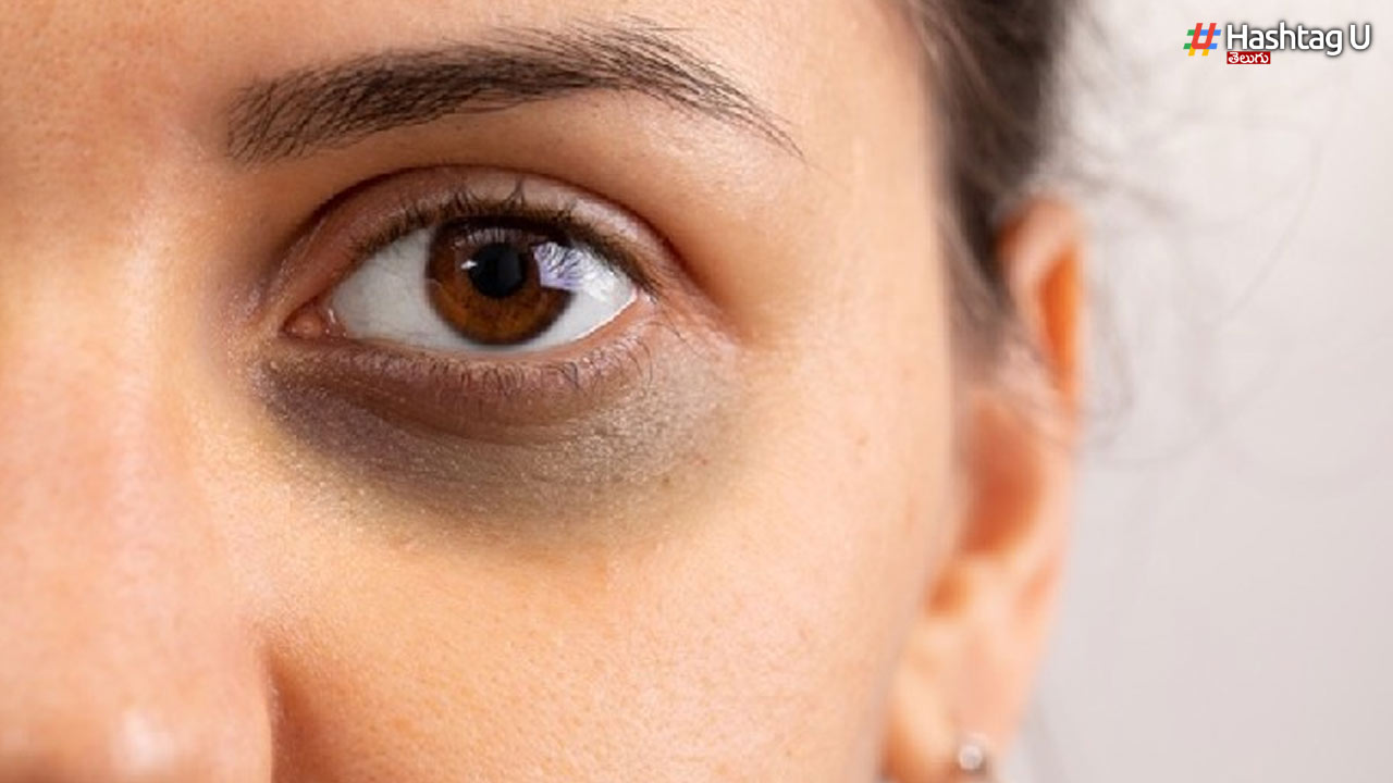 Do You Know How To Reduce Dark Circles Under The Eyes..