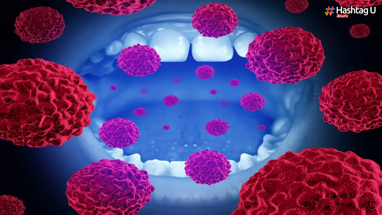 Oral Cancer
