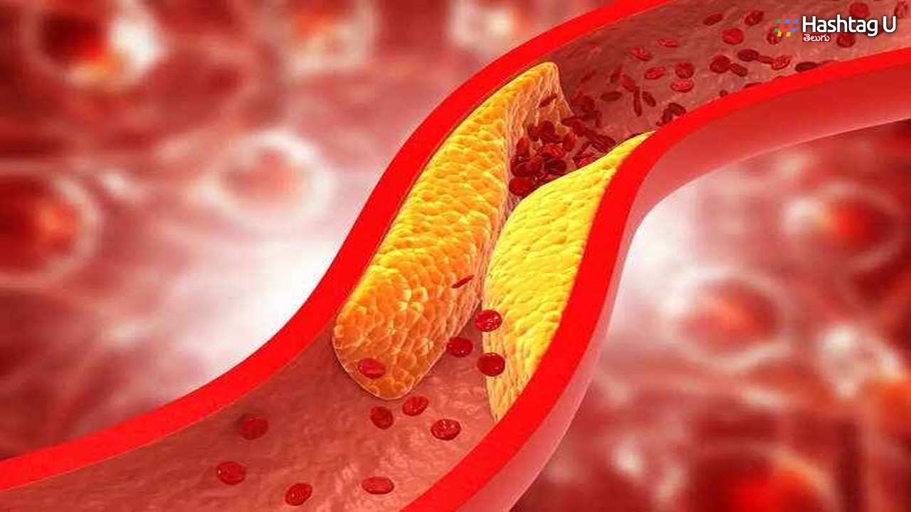 High Cholesterol