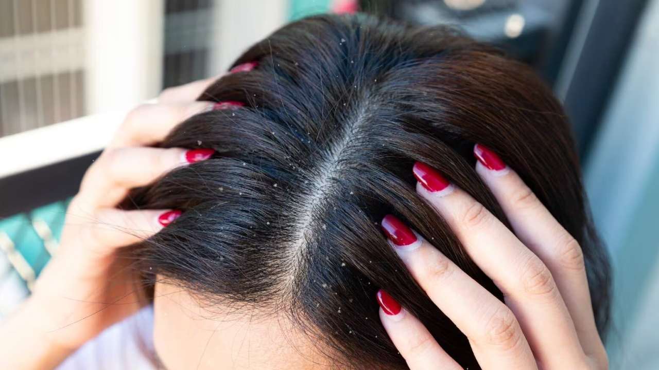 Dandruff