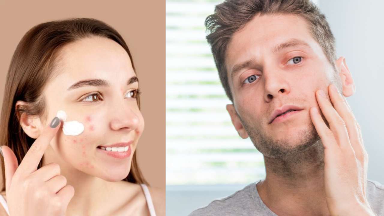 How to Reduce Pimples with home made tips