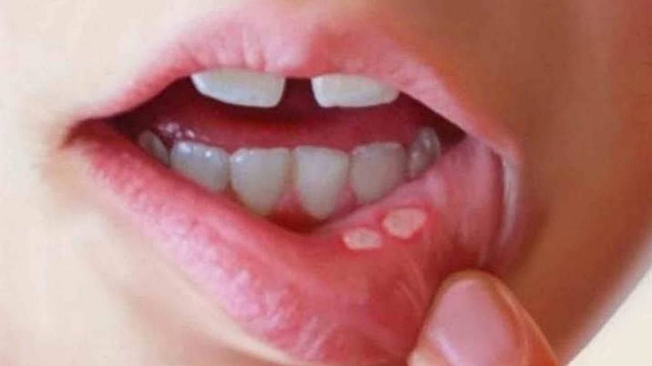 Ulcer