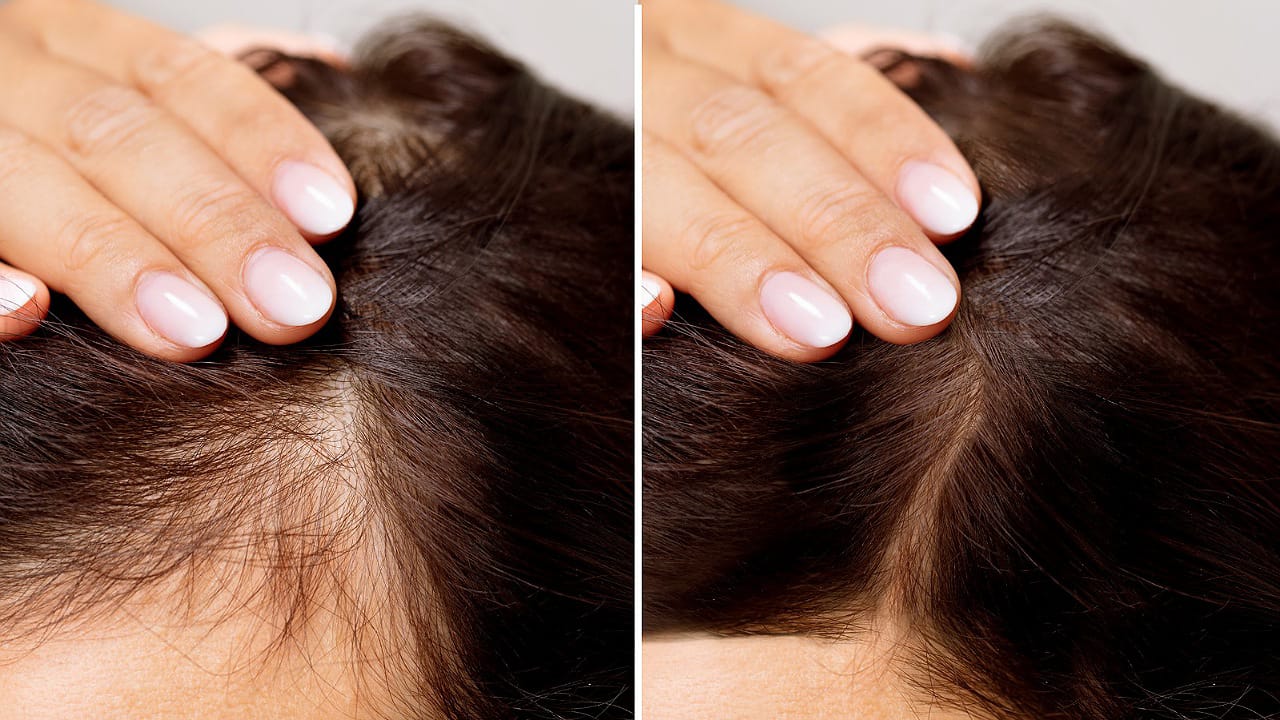 Hair Loss Prevention