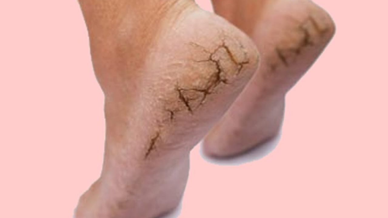 Cracked Heels