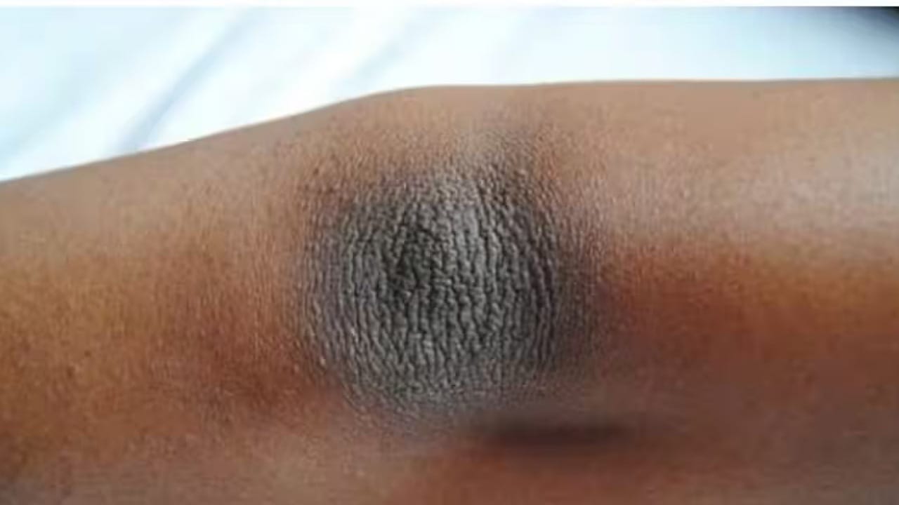 Lighten Dark Elbows