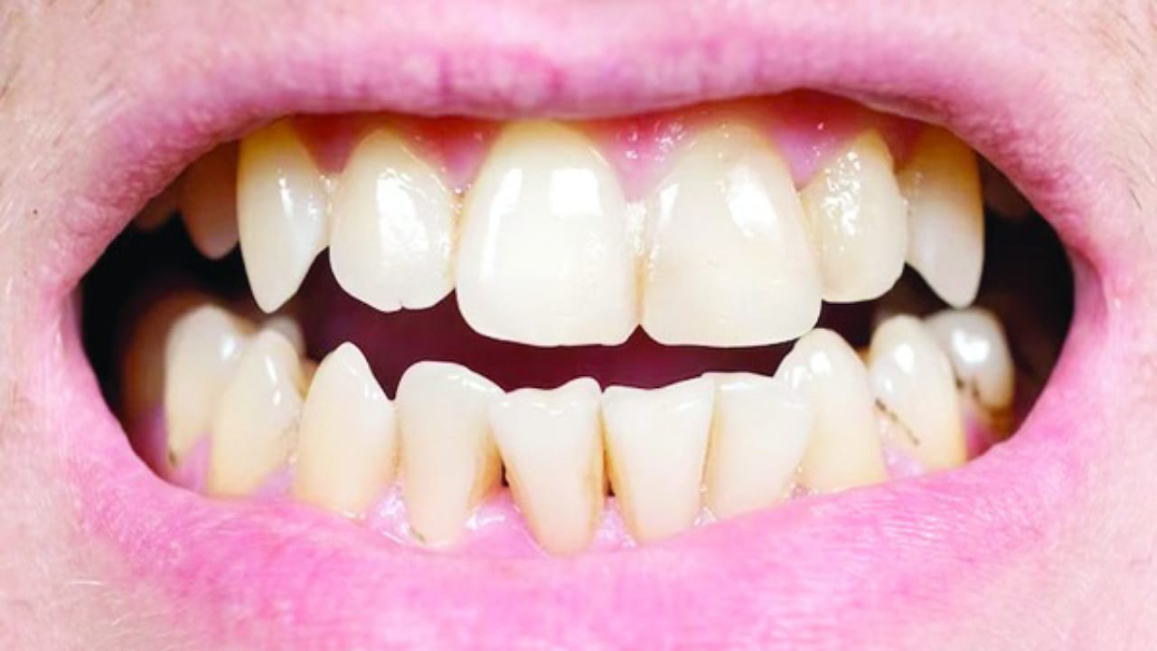 Teeth Tips