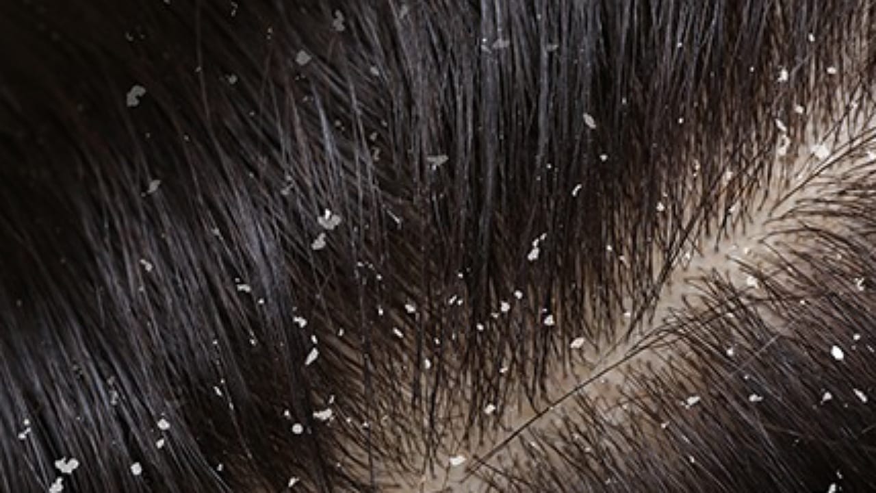 Tips To Remove Dandruff
