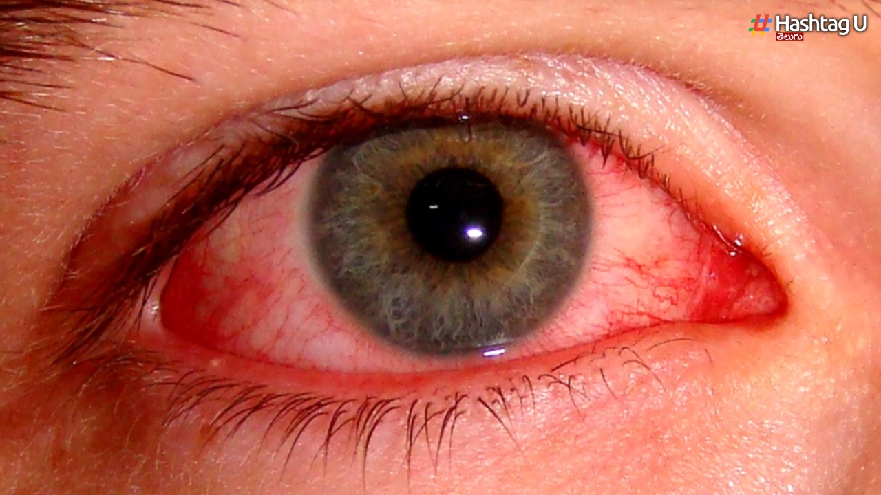 Conjunctivitis