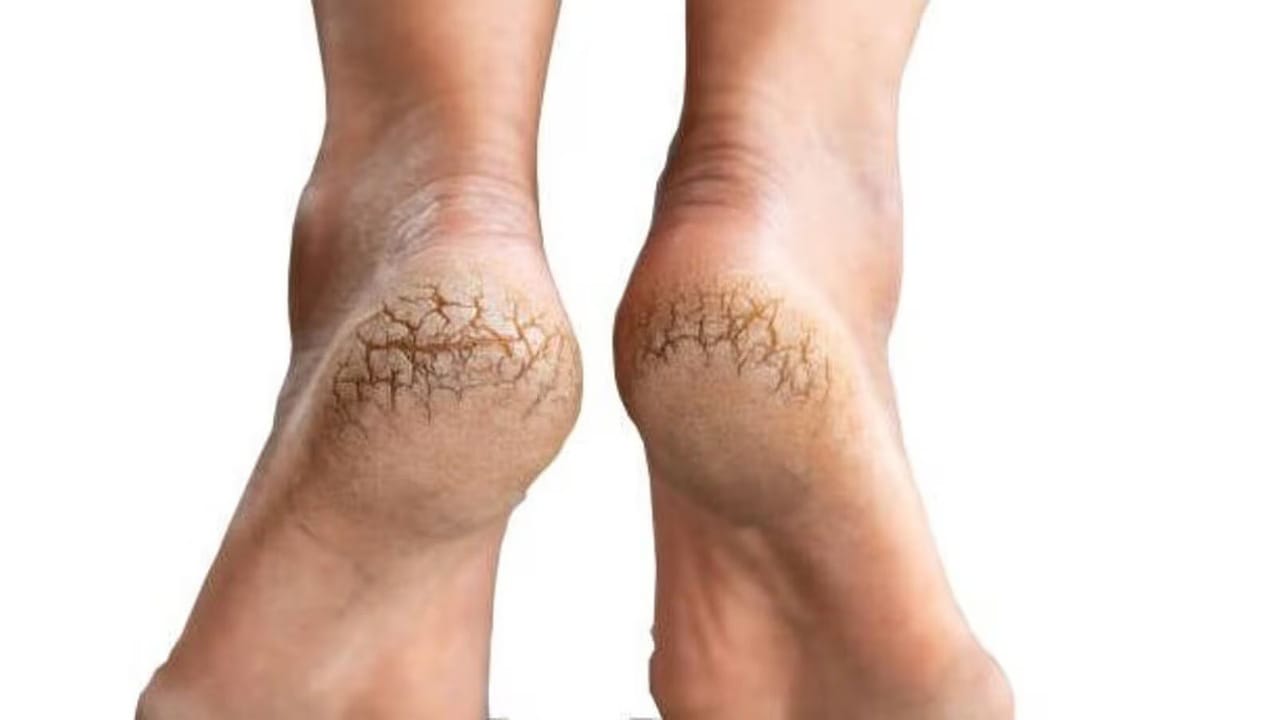 Cracked Heel