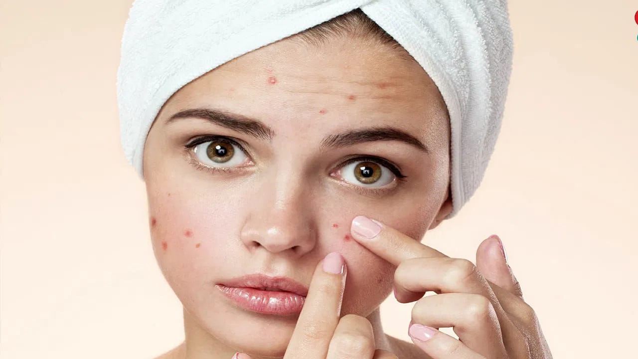 Hormonal Breakouts