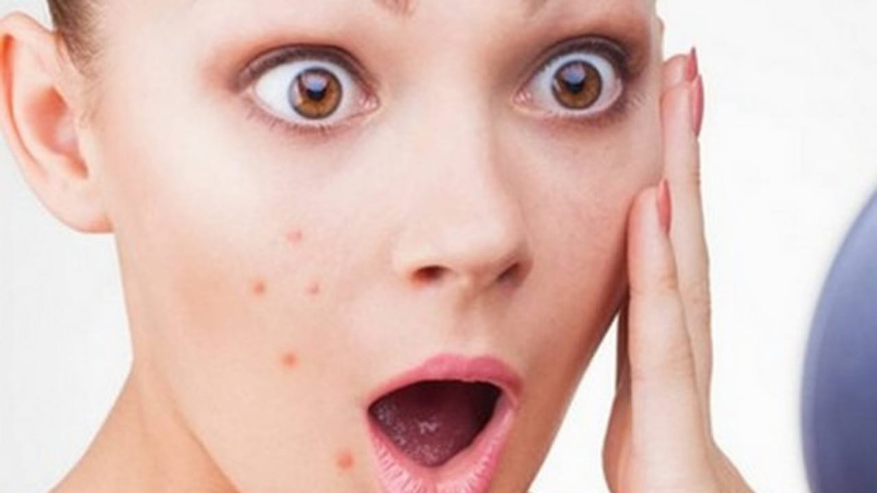 Pimples And Hair Loss