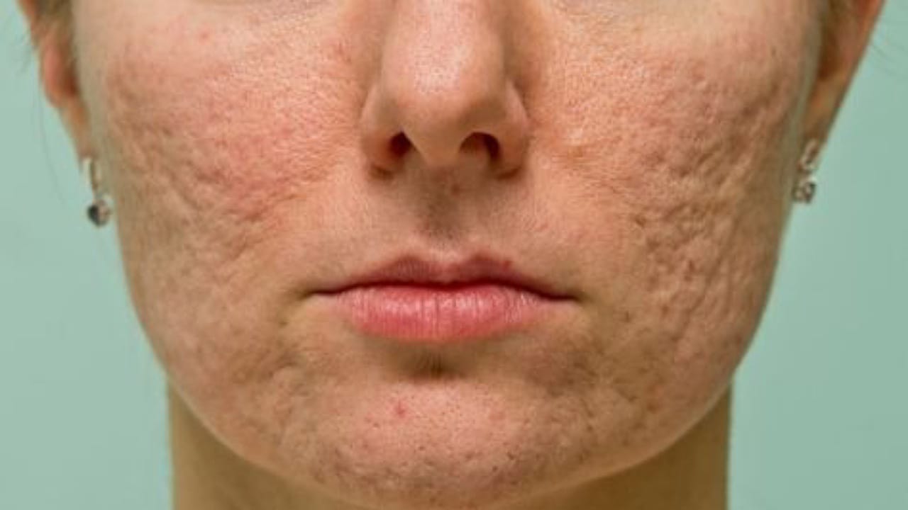 Pores On Face