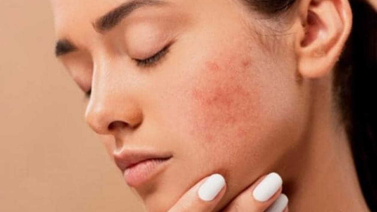 Dry Skin