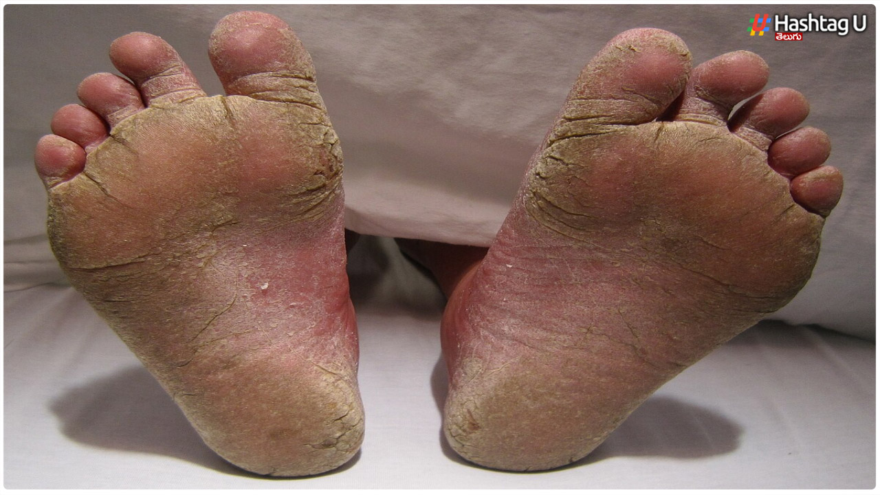 Are You Suffering From Cracked Feet.. But This Leaf Has To Be Used Like That..