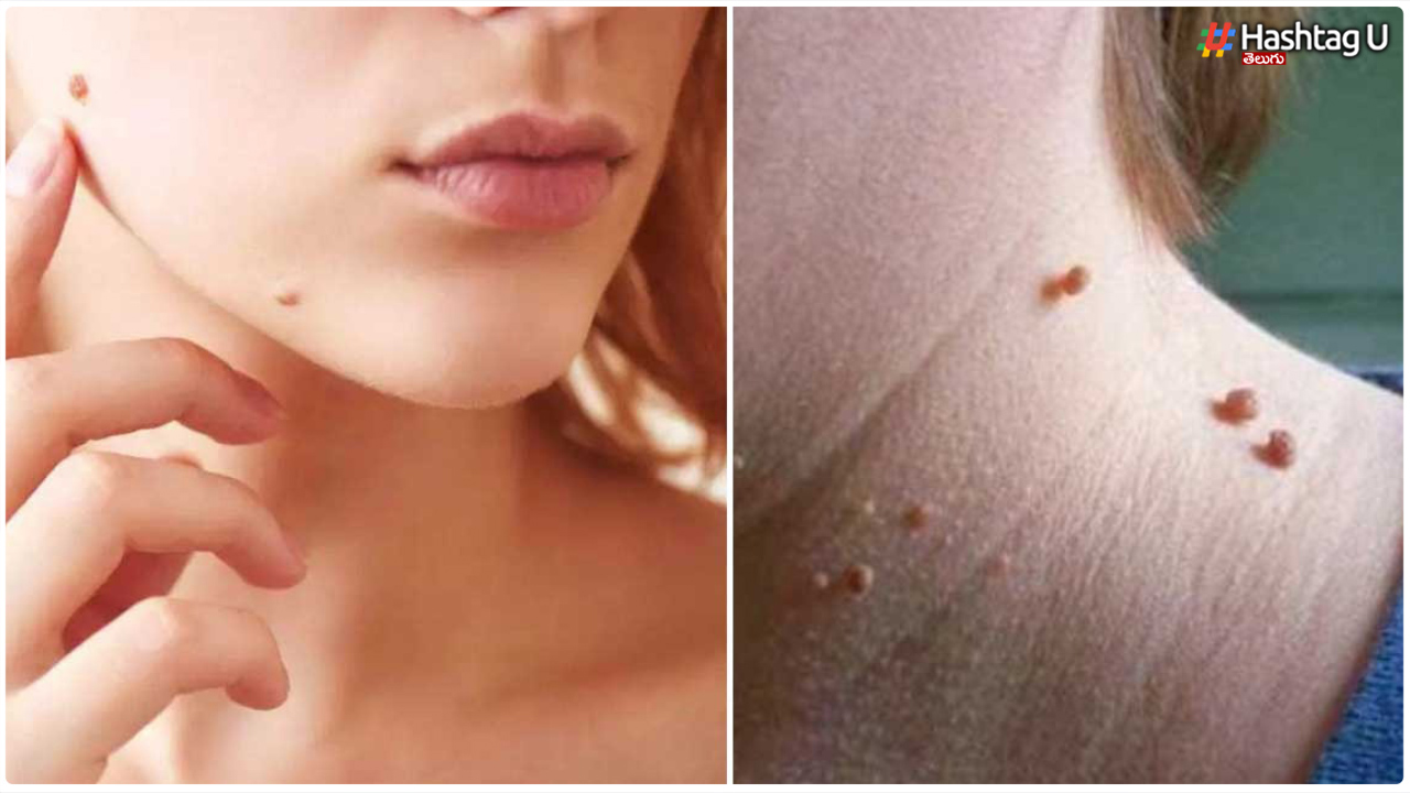 Health Tips... Do You Have A Lot Of Pimples..but Once You Write This Is Enough...the Pimples Should Disappear Overnight..
