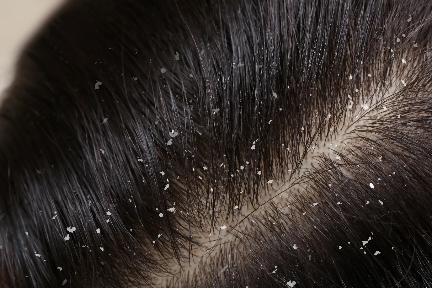 Learn Difference Between White Piedra And Dandruff