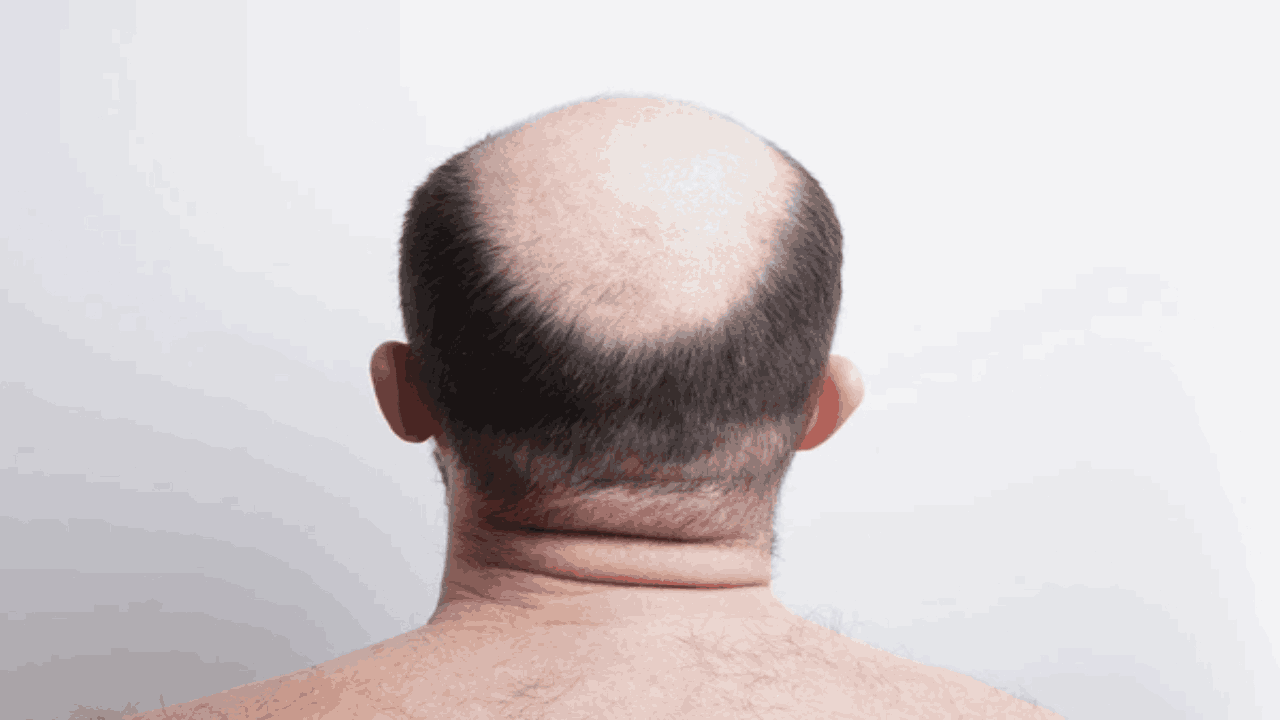 Bald Head