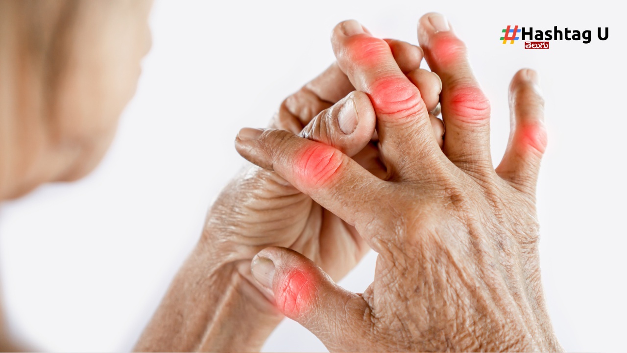 Arthritis