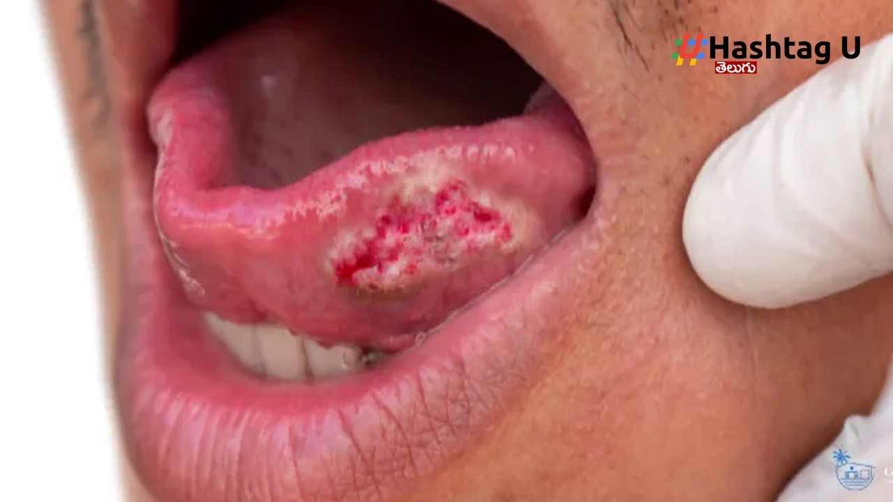 Oral Cancer