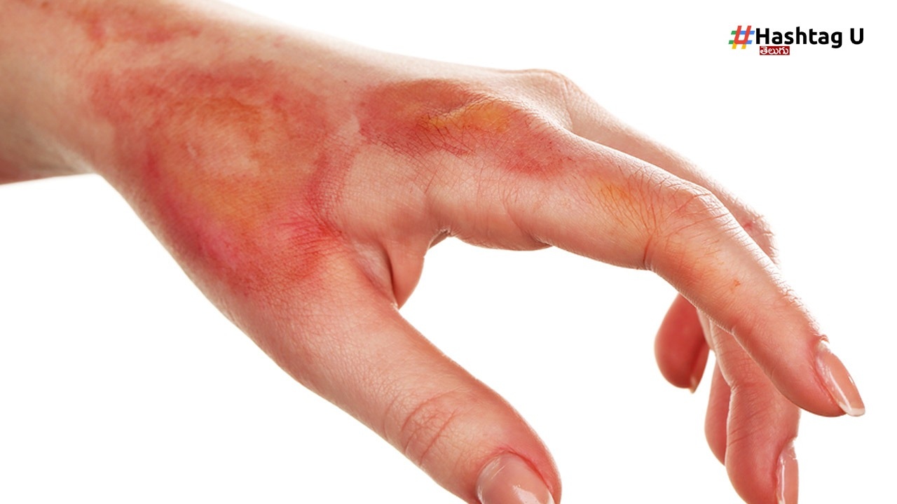 Burn Injuries