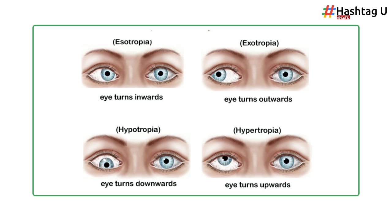 Congenital Squint