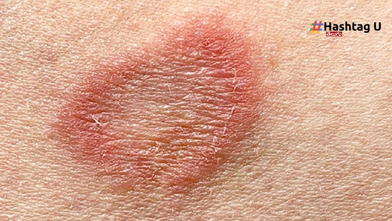 Ringworm